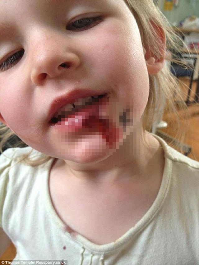 Olivia saat terjatuh dan mengalami luka di bibir | Photo: Copyright dailymail.co.uk