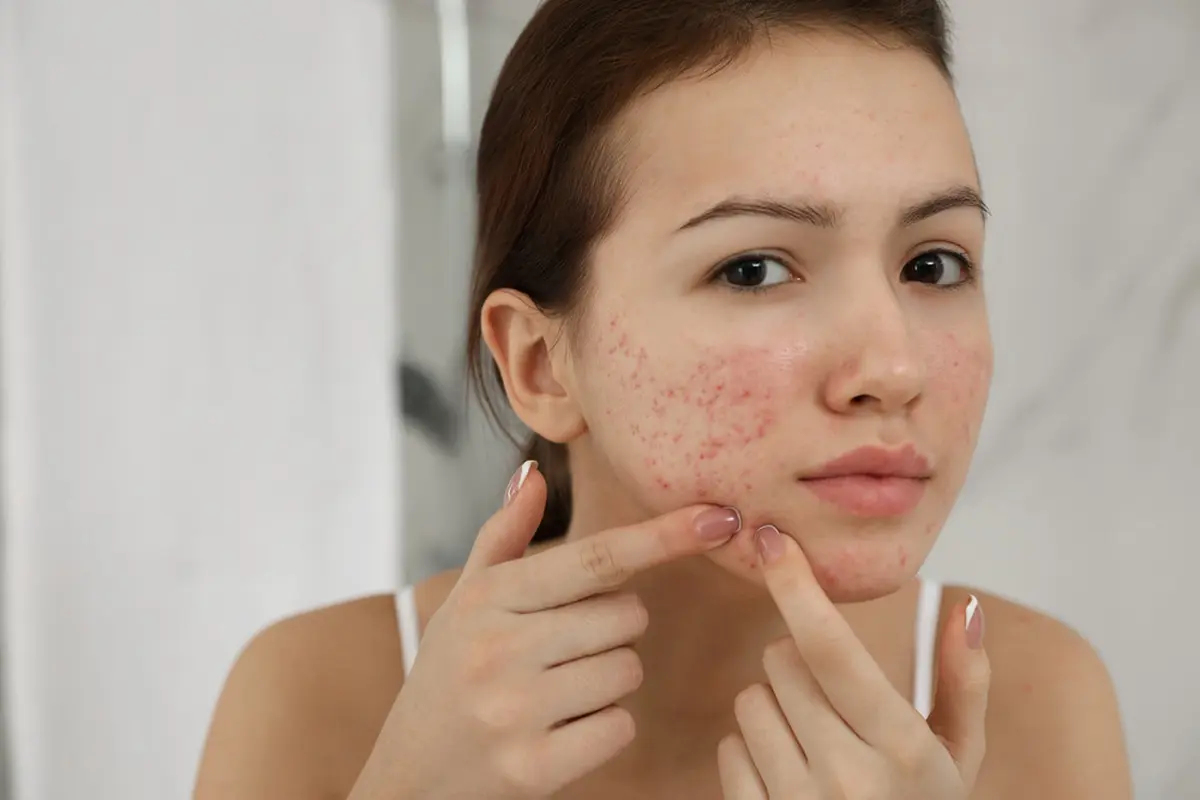 ilustrasi efek samping salicylic acid untuk kulit jerawat/New Africa/shutterstock