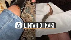 Perempuan itu menemukan lintah yang sudah menghisap darahnya di dalam kaos kaki.