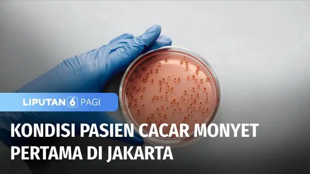 Kementerian Kesehatan mengkonfirmasi, satu warga Jakarta, positif Cacar Monyet atau Monkeypox. Pasien berumur 27 tahun tersebut kini melakukan isolasi mandiri lantaran memiliki gejala ringan.