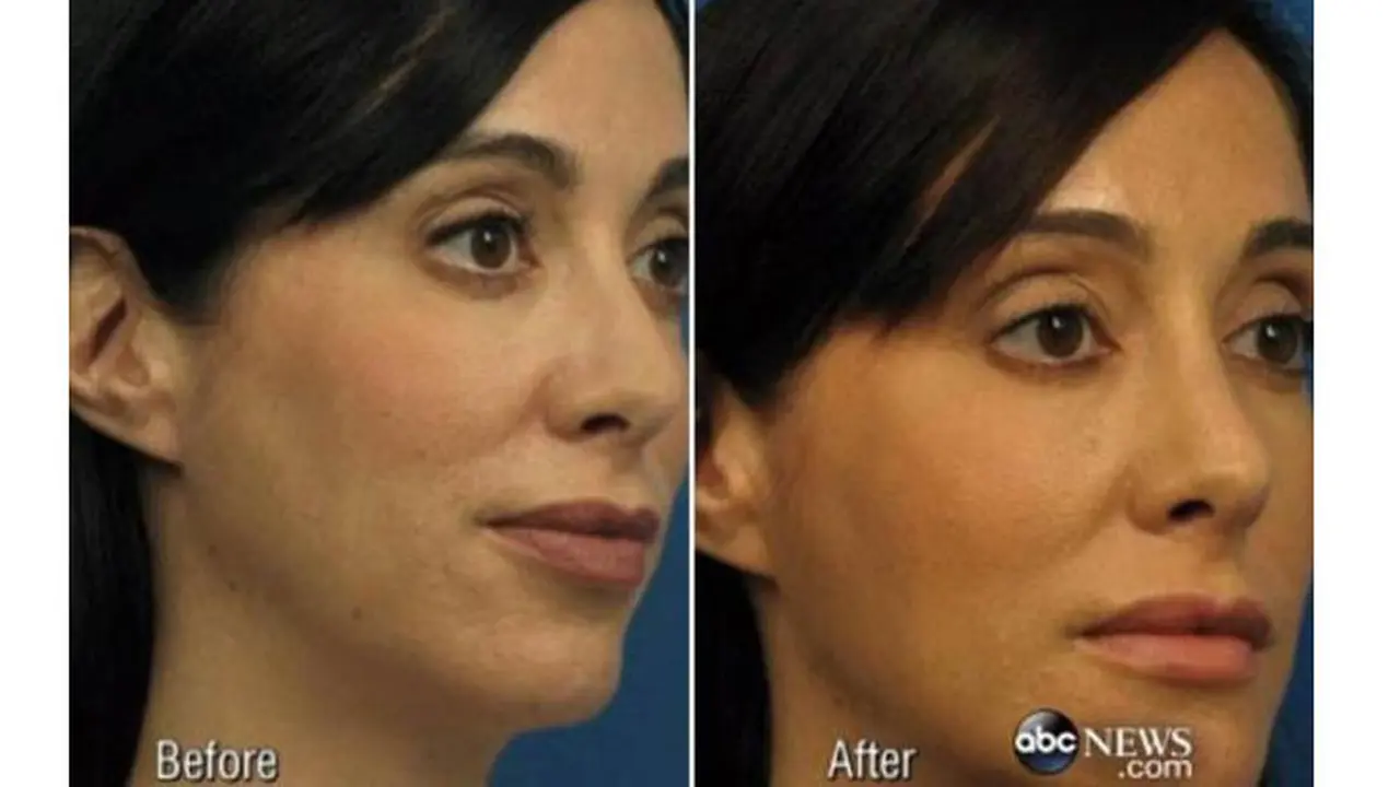 Lavey Operasi Plastik Agar Terlihat Cantik Seperti di Photoshop