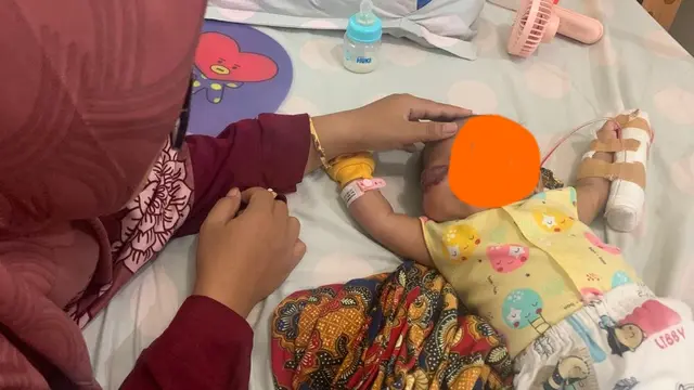 Hemangomia di dekat mata bayi. (Foto: Liputan6.com/Dok. RSI Banjarnegara)
