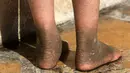 Doaa, bocah berumur lima tahun memperlihatkan kulit kakinya yang berubah akibat dampak bom kimia di Qayyara, Irak, (12/11). Militan ISIS telah membakar pabrik kimia yang menyebabkan tersebarnya zat-zat kimia ke warga sekitar. (REUTERS/Air Jalal)