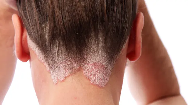 Gejala Psoriasis