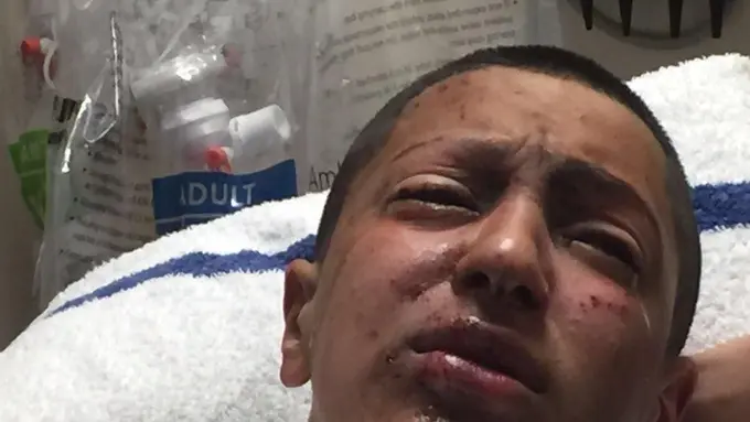 Coba Rokok Elektrik, Satu Mata Bocah Ini Jadi Buta