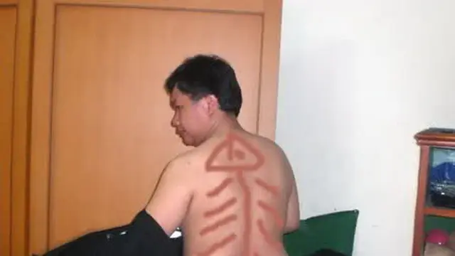 6 Motif Kerokan Antimainstream Ini Bikin Geleng Kepala