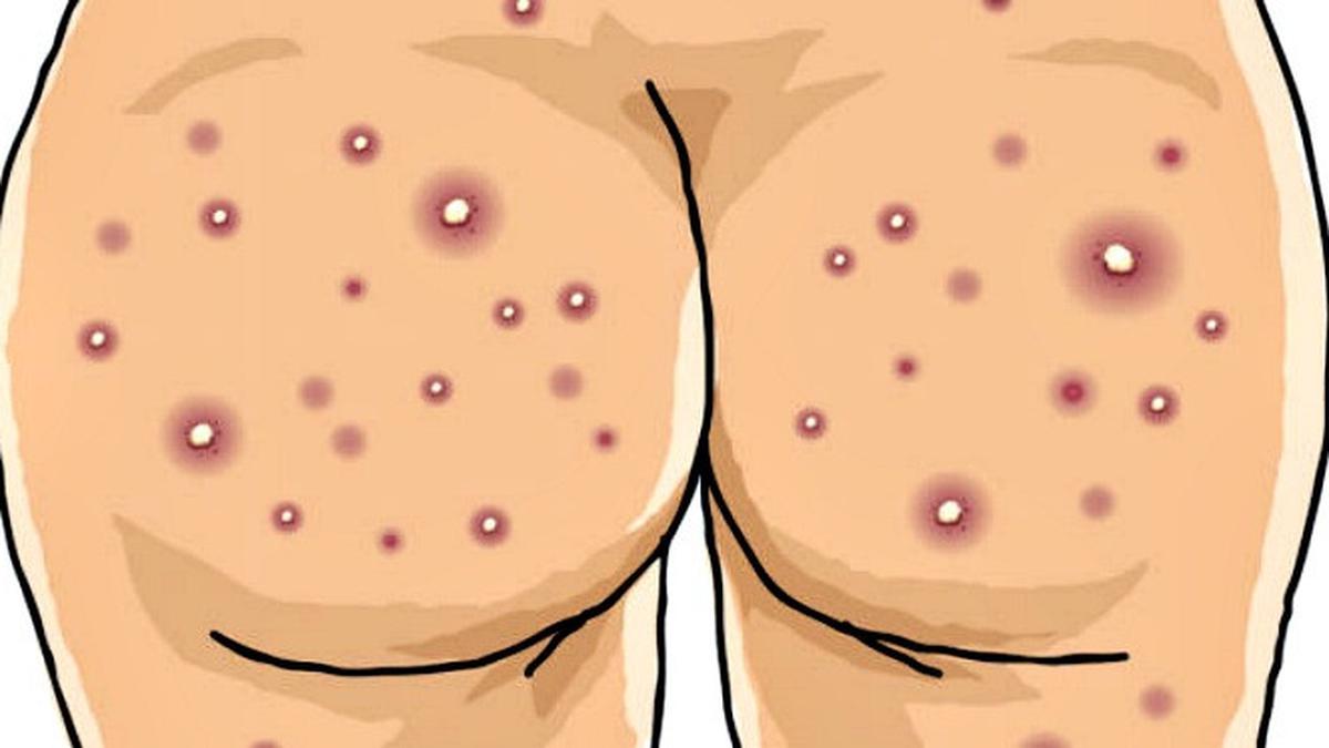 Jerawat Bokong Muncul Karena Terlalu Sering Kenakan Celana Ketat - Health  Liputan6.com