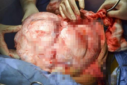 Tumor sebarat 17 kg dari tubub Devi | Photo: Copyright metro.co.uk