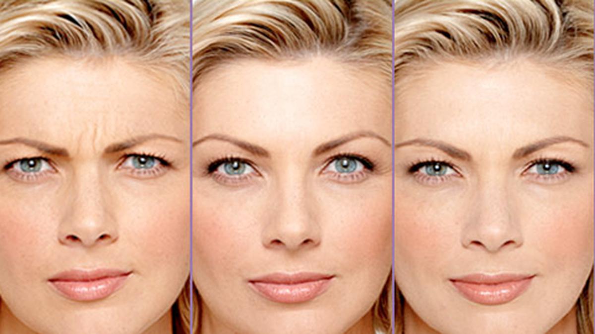 Botox Sangat Aman dan Tanpa Efek Samping - Health Liputan6.com