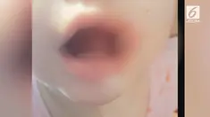 Bayi asal Kentucky, Amerika Serikat, mengalami luka di bibir akibat menelan charger HP.