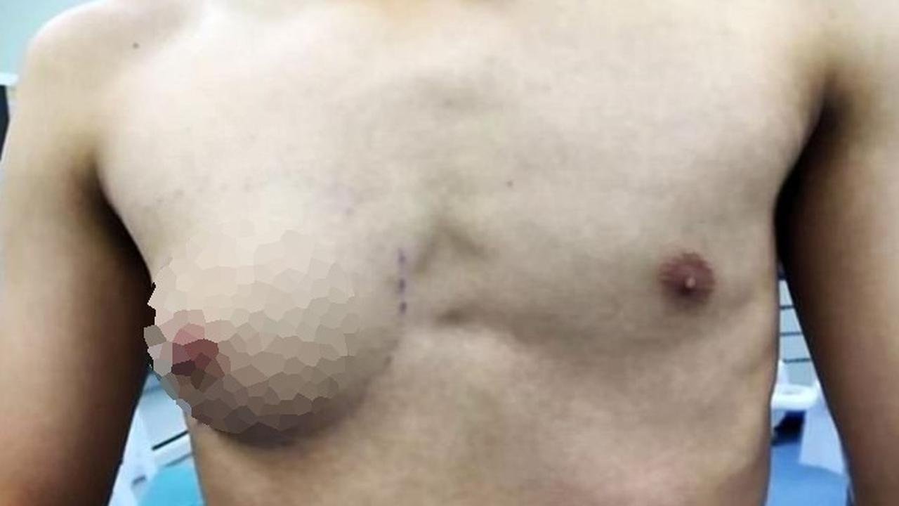 Hobi Makan Fast Food, Dada Remaja Pria Tumbuh Seperti Wanita