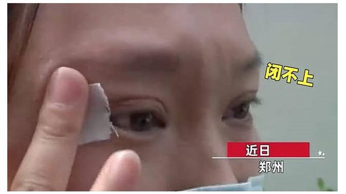 Gagal Operasi Plastik, Kelopak Mata Wanita Ini Tak Bisa Tertutup Selama Setahun (Sumber: Oddity Central)