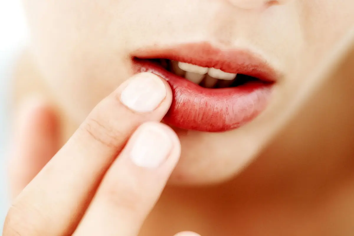 Bibir Pecah-pecah dan Kering? Atasi Dengan Cara Ini