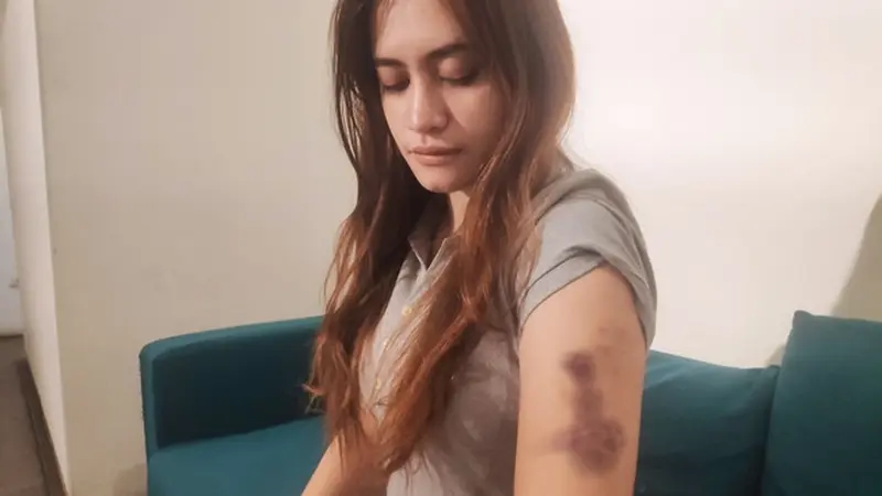 Korban penganiayaan Polwan memperlihatkan luka yang dialaminya kepada wartawan.
