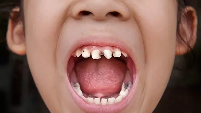 Penyebab Gigi Anak Mudah Rapuh dan Menghitam
