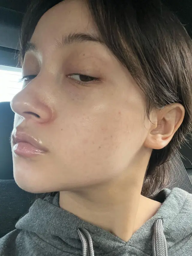 7 Potret Megan Domani Pamer Wajah Berjerawat, Sempat Takut Bertemu Orang Lain
