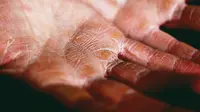 Garam Himalaya dapat digunakan untuk mengobati masalah kulit seperti eksim. (Foto: Unsplash/Alexander Grey)
