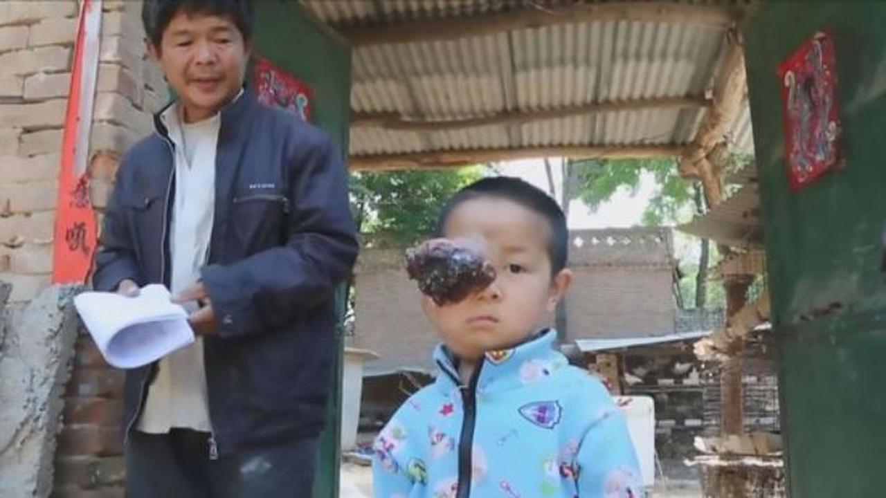 Derita Tumor Ganas, Dokter Tak Mau Operasi Mata Bocah Ini