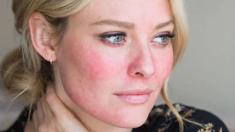 penyakit kulit rosacea