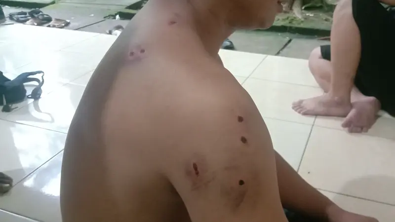 Luka Tembakan Air Soft Gun Di Tubuh Korban Begal. (Kamis, 20/05/2021). (Liputan6.com/Yandhi Deslatama).