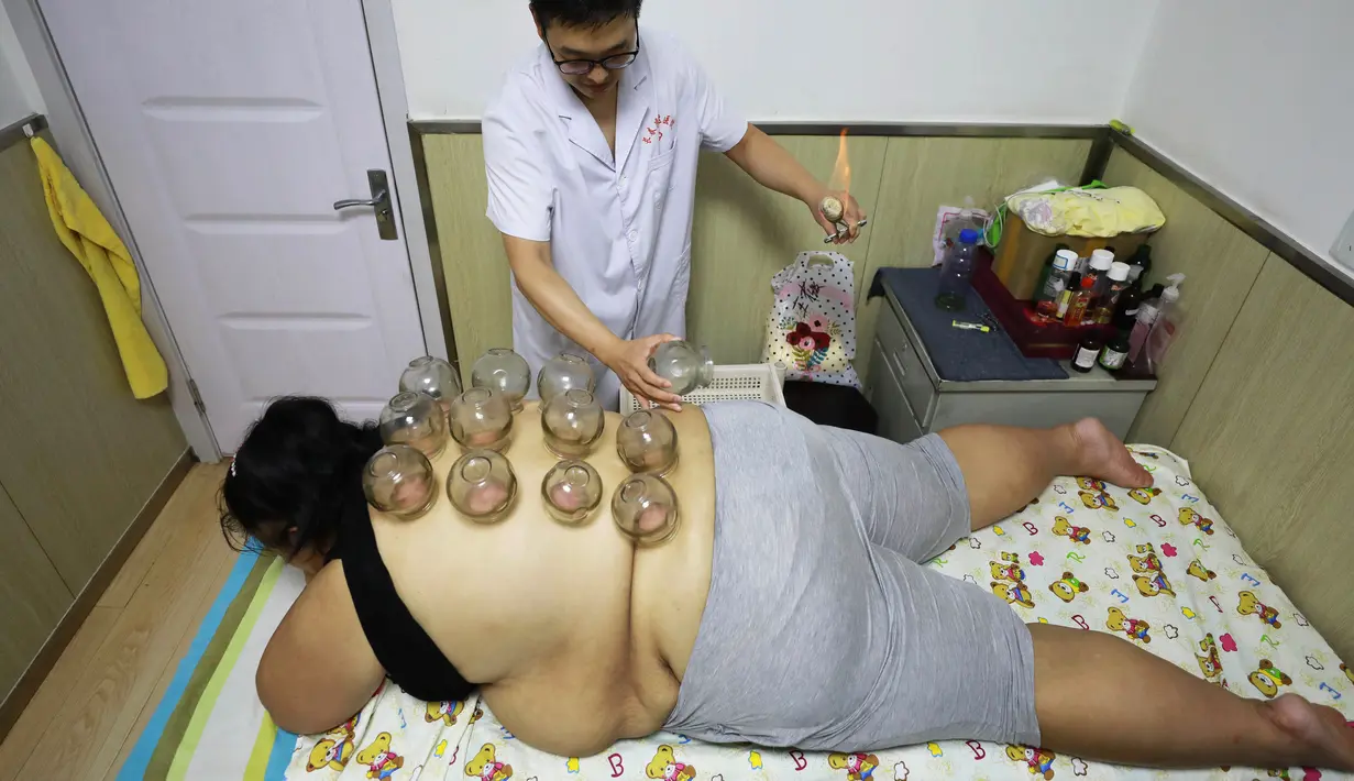 Wanita obesitas menerima terapi bekam di sebuah klinik penurun berat badan di Changchun, Jilin, China, Selasa (17/7). Pengobatan tradisional ini digunakan untuk membantu meningkatkan metabolisme, membakar lemak, dan mengurangi rasa lapar. (STR/AFP)