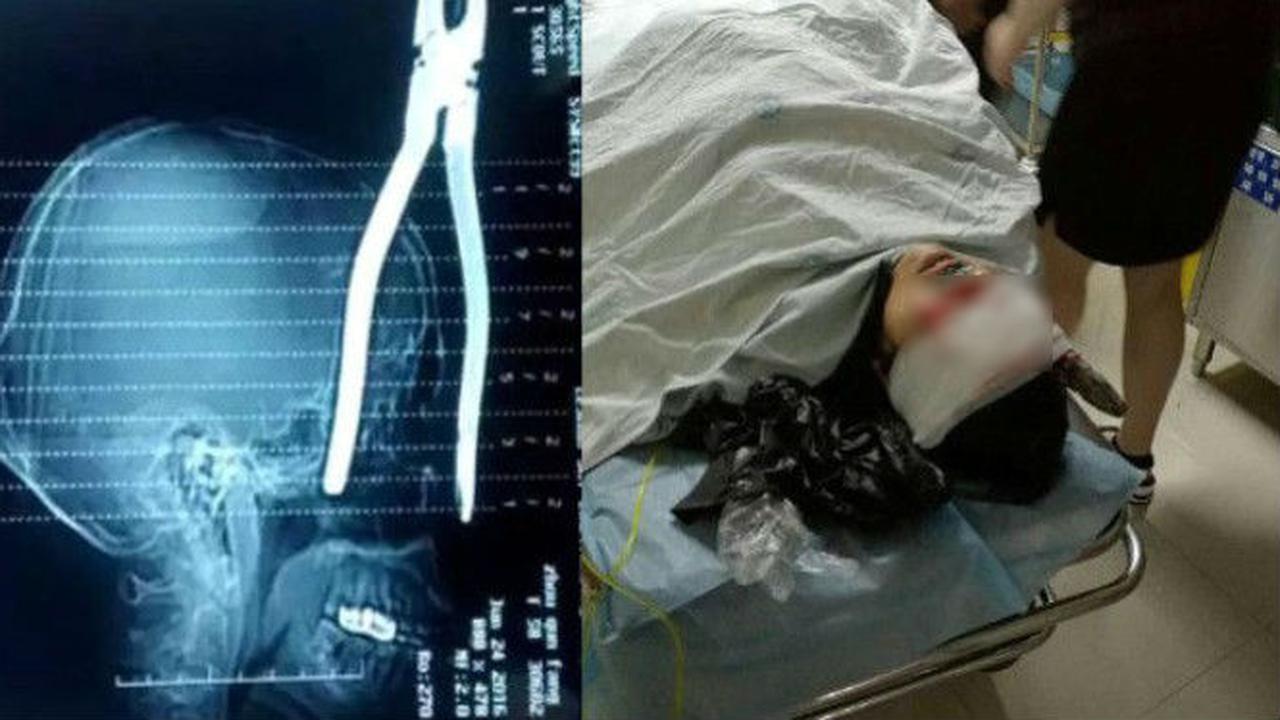 Tertembus Tang di Kepala, Nenek Hebat Ini Bertahan Hidup