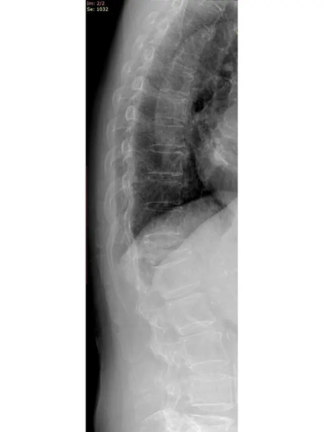 Kenali Lebih Dini Osteoporosis dan Osteoarthritis