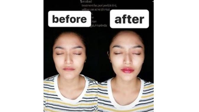 6 Potret Terbaru Siti Badriah Setelah Filler Bibir, Makin Seksi (sumber: Instagram.com/rezagladys)