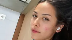 Inilah potret Estelle Linden yang terlihat pede memamerkan wajah dengan jerawat di pipi. Wanita 26 tahun ini tetap cantik meski tanpa polesan makeup. (Liputan6.com/IG/@estelleelinden).