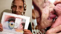 Nenek 80 Tahun Mampu Obati Kebutaan dengan Menjilat Bola Mata