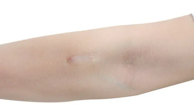 Bagaimana Cara Menghilangkan Keloid?