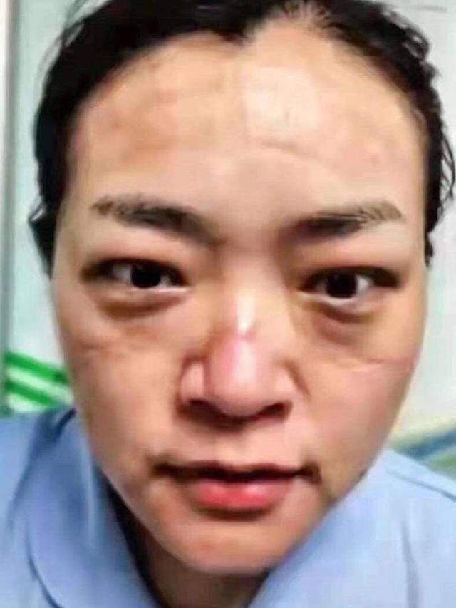 7 Potret Luka Lebam di Wajah Tim Medis Akibat Kacamata Pelindung Selama Perangi Virus Corona