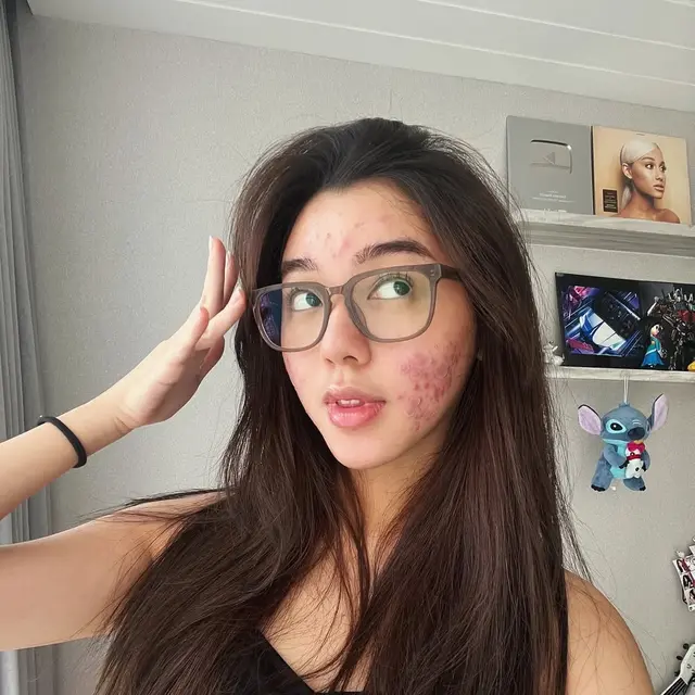 6 Potret Wajah Gabriella Ekaputri Berjerawat, Tetap Percaya Diri Tampil Natural