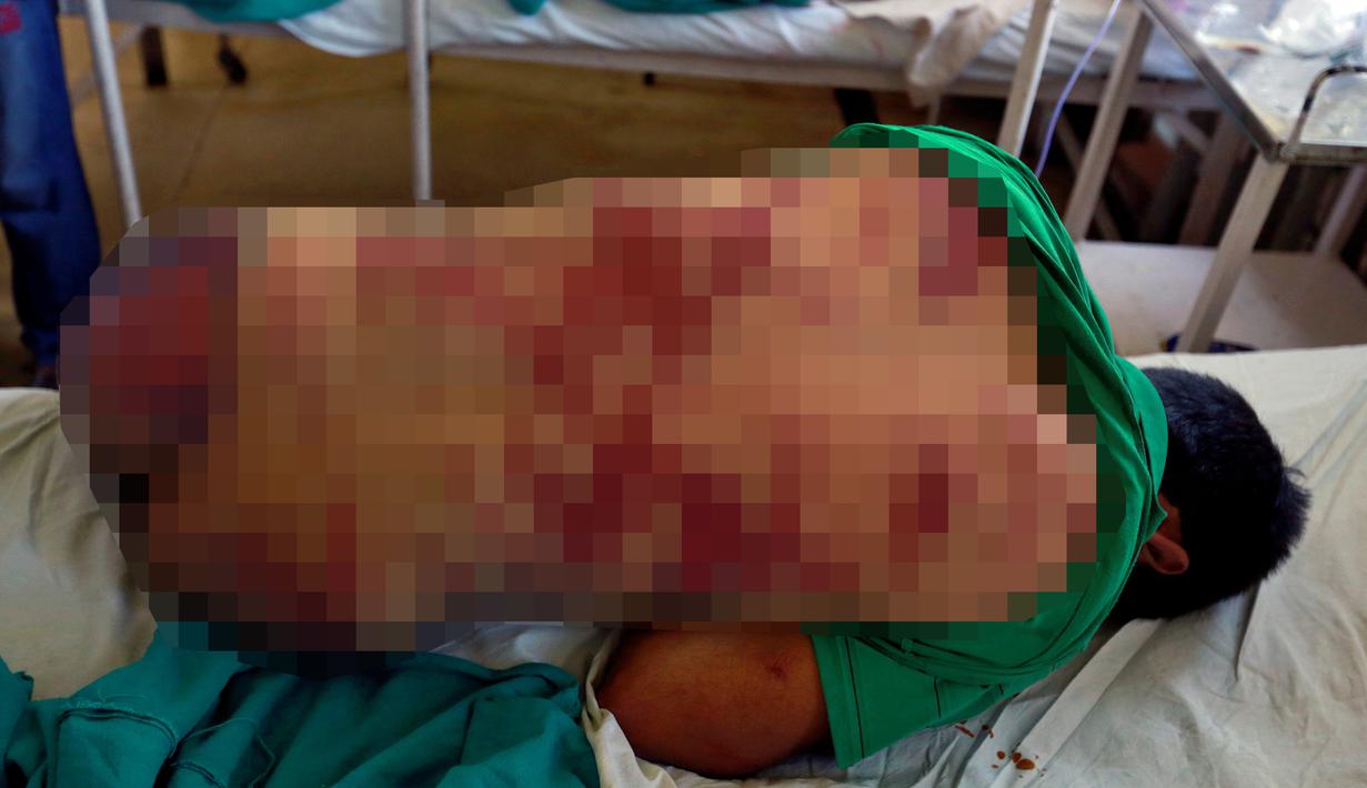 Salah satu korban yang mengalami luka akibat kerusuhan di Srinagar, Kashmir, Kamis (18/8). Sedikitnya lima orang tewas dan 20 lainnya mengalami luka parah akibat bentrok antara warga dan petugas keamanan. (REUTERS)