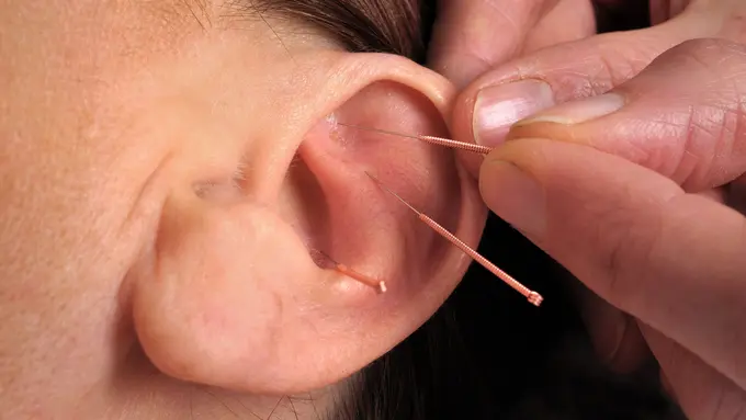 [Bintang] Akupunktur telinga
