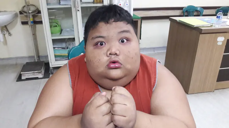 Seusia Arya, Bocah Obesitas Palembang Ini Berbobot 119 Kilogram