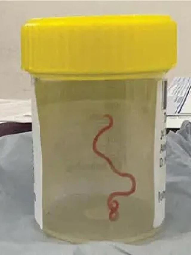 Ahli bedah menemukan cacing parasit sepanjang 3 inci yang dikenal sebagai Ophidascaris robertsi .