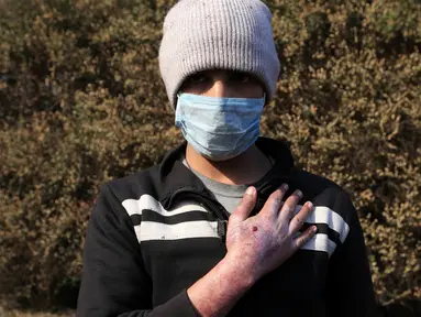 Sirhan Awwad menunjukkan kondisi tanganya setelah terkena dampak bom kimia yang dilancarkan oleh militan ISIS di Qayyara, Irak (12/11). Militan ISIS dilaporkan telah melakukan aksi membakar pabrik kimia. (REUTERS/Air Jalal)