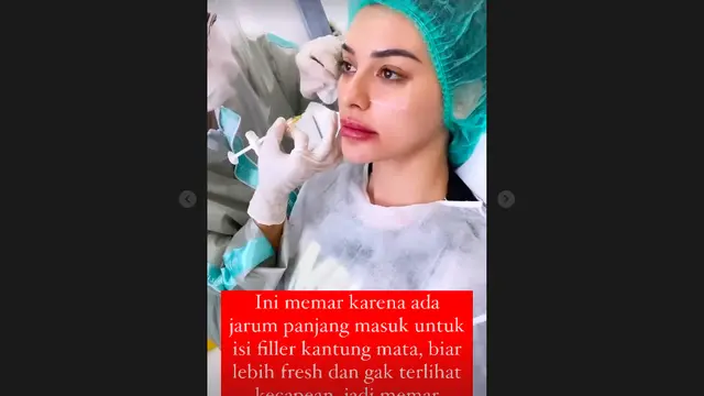 Nora Alexandra Bantah Wajahnya Lebam Karena Dipukul, Beber Fakta Sesungguhnya. (instagram.com/ncdpapl)