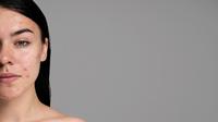 Masalah kesehatan kulit, seperti jerawat juga bisa muncul akibat dari tidur dengan rambut basah. (Sumber: Freepik).