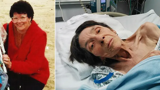 Anna sebelum sakit dan saat ini | Foto: copyright dailymail.co.uk