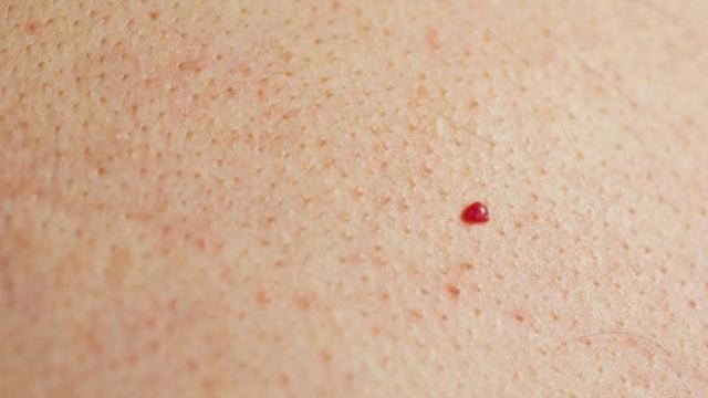Cara Menghilangkan Bintik-Bintik Kecil di Tangan yang Efektif, Berikut ...