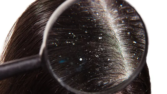 Ketombe Menyerang? Ini Cara Tepat untuk Mengatasinya (Goncharov Artem/Shutterstock)