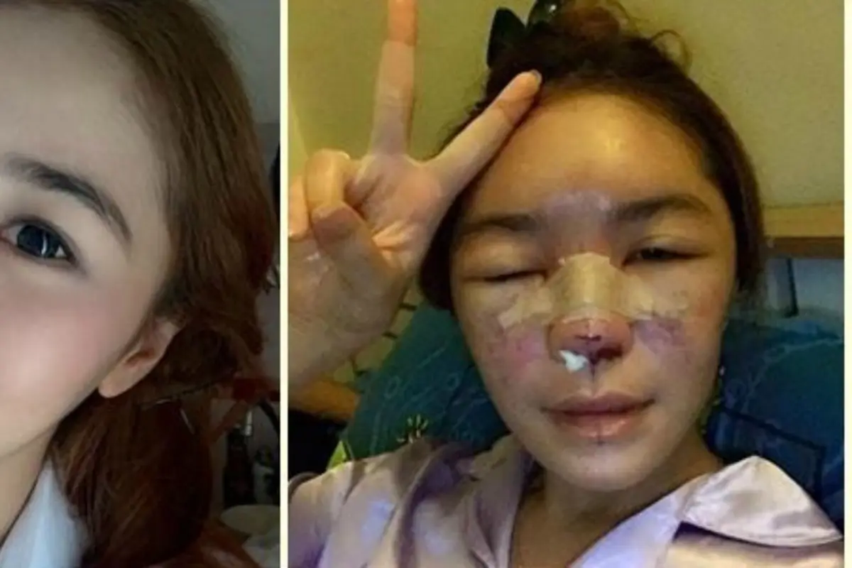 Gara-gara Suntik Silikon, Model ini Berubah Jadi Buruk Rupa