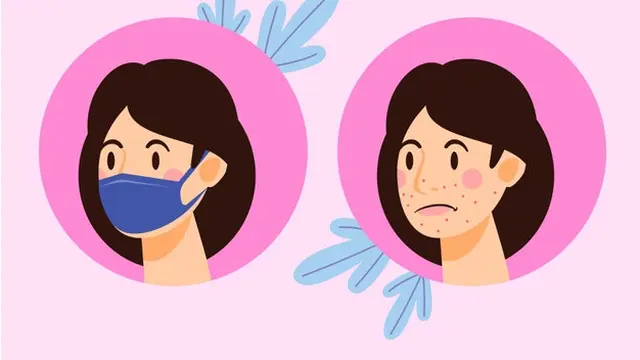 Gambar Ilustrasi Kulit Berjerawat Karena Masker