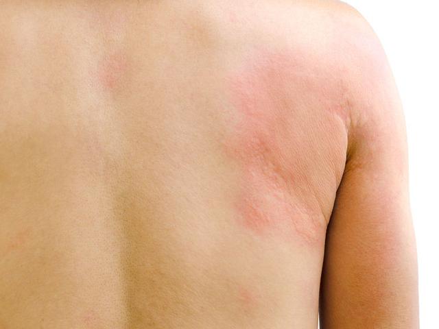 6 Penyebab Biduran Dan Pengobatannya Ragam Bola Com