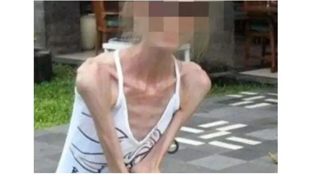 Terobsesi Jadi Langsing, Wanita 30 Tahun Ini Hanya Memiliki Bobot 25 Kg