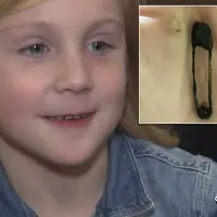 Seorang gadis (5) tak sadar kalau sebuah peniti tersangkut dalam hidungnya selama enam tahun. 