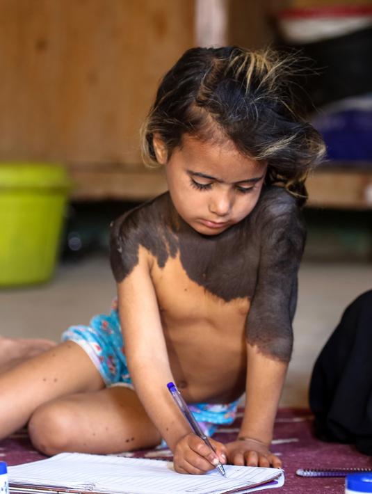 Houra saat menulis di rumahnya di desa Wahed Haziran, Provinsi Diwaniya, Irak, (17/3). Perawatan cangkok kulit dan laser disarankan untuk Houra agar penyakit dapat teratasi. Houra juga disarankan mendapatkan bantuan psikologi. (AFP Photo/Haidar Hamdani)