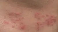 Perempuan Lebih Rentan Kena Cacar Api atau Herpes Zoster, Ini Alasannya